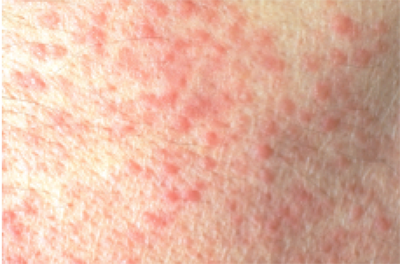 What causes small pimples on the arms?